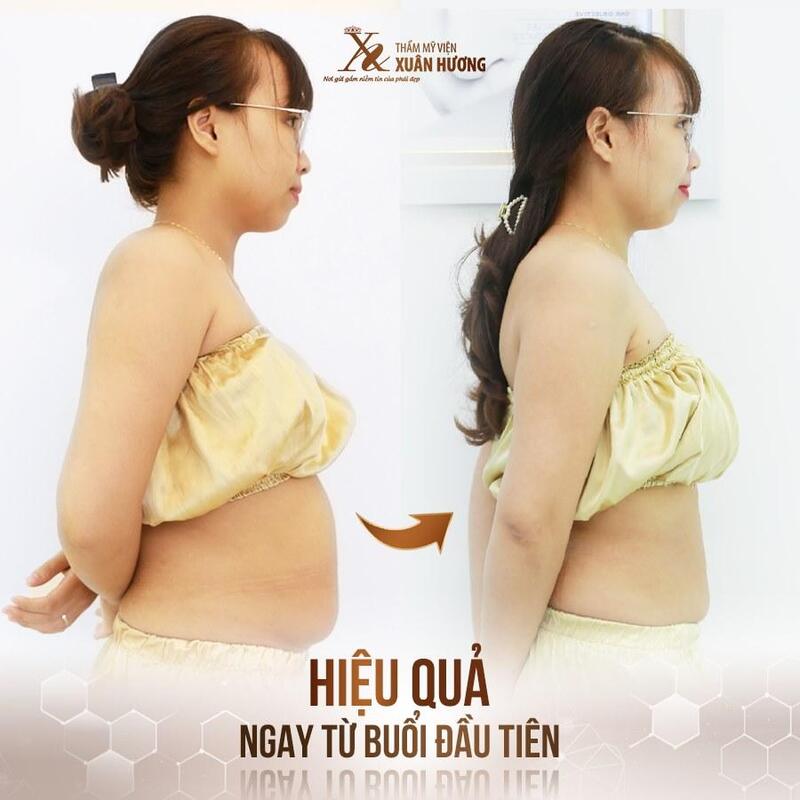 Hiệu quả giảm béo rõ rệt sau buổi đầu tiên tại Thẩm mỹ viện Xuân Hương