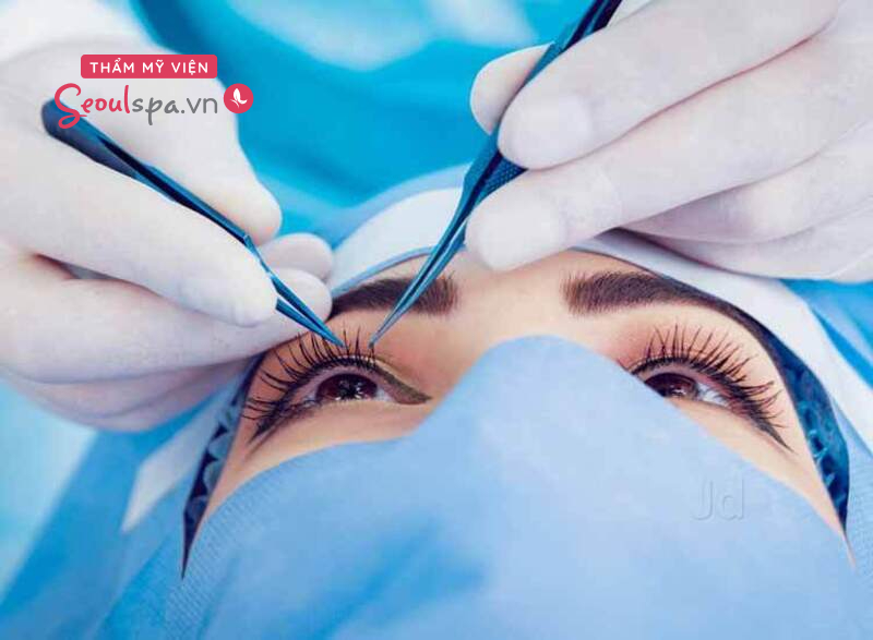 Phẫu thuật cơ mắt
