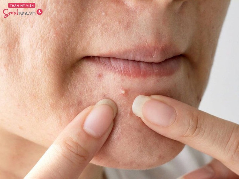 Không nên tự nặn mụn bọc không đầu tại nhà nhằm tránh viêm nhiễm vết mụn