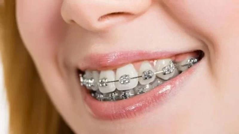 Chi phí niềng răng hô nhẹ dao động từ 10.000.000 - 25.000.000 triệu đồng/ hàm