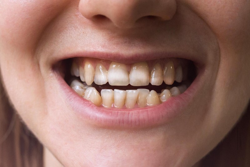 Nước bò húc có thể gây hỏng men răng, khiến răng bị ố vàng