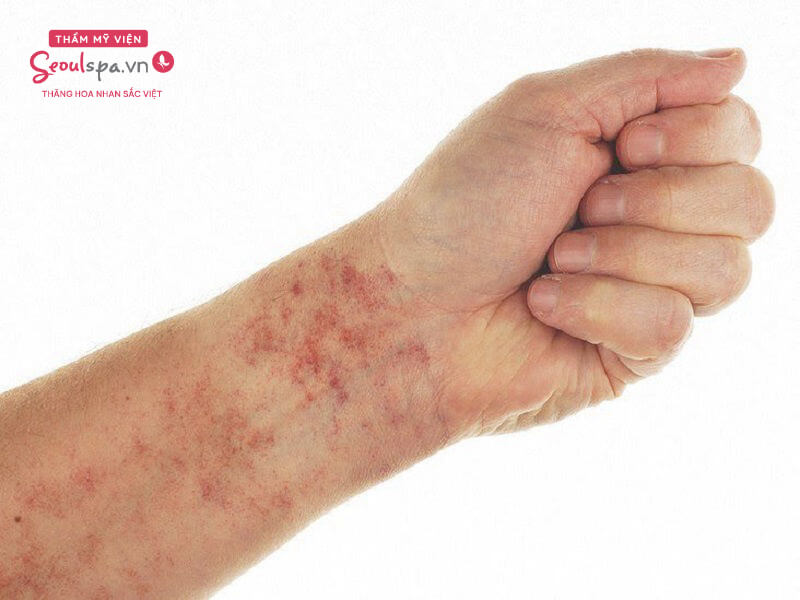 Người bệnh suy tủy bị xuất huyết dưới da xuất hiện nhiều chấm đỏ li ti