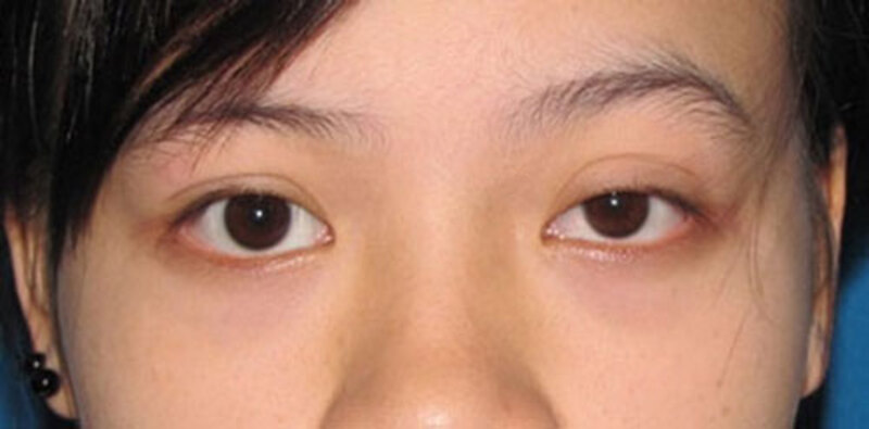 Làm sao để khắc phục tình trạng mắt cao mắt thấp?