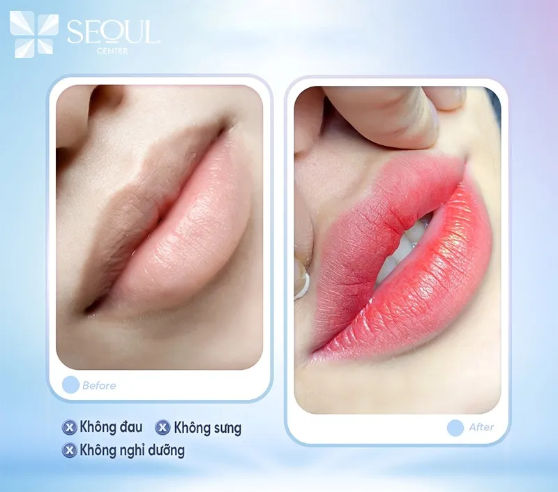 Hình ảnh môi trước và sau khi phun với hiệu ứng màu sắc tự nhiên, đều màu tại Seoul Center