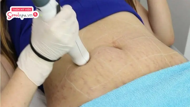 Trị rạn da bằng laser bao nhiêu tiền?