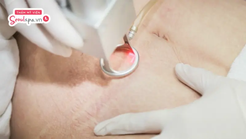 Nên lựa chọn dịch vụ điều trị rạn da bằng laser tại những địa chỉ uy tín, có cung cấp đầy đủ chính sách bảo hành